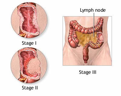 colorectal cancer