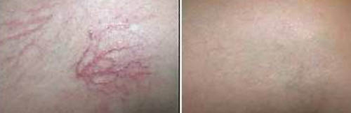 Spider Veins Spider Veins