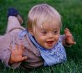 Down Syndrome